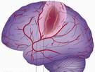 Phòng ngừa tai biến mạch máu não thế nào cho hiệu quả?
